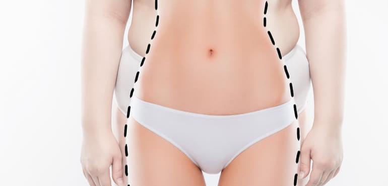 Qual a diferença entre lipoaspiração e lipoescultura? Descubra!