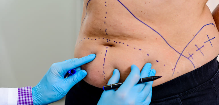 Abdominoplastia na terceira idade: conheça os cuidados importantes