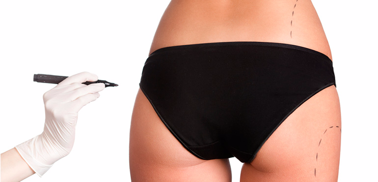 Conheça as características e indicações da gluteoplastia de aumento