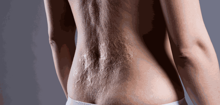 Cirurgia plástica reparadora: Entenda como ex-obesos e pessoas com cicatrizes podem ser beneficiadas