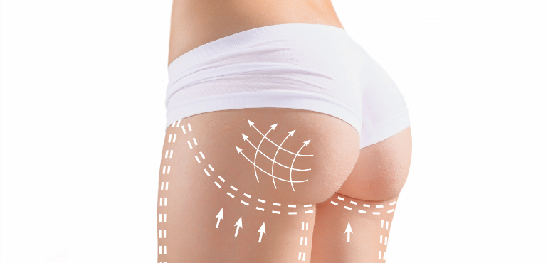 Quais são os tipos de prótese da Gluteoplastia de aumento ?