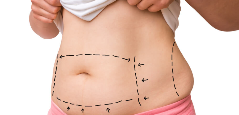 Entenda como é realizada a abdominoplastia