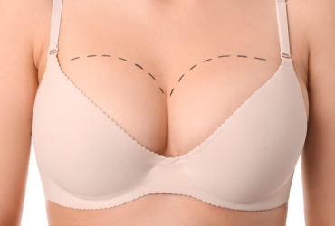 Mamoplastia de redução: o que é e por que está tão em alta?