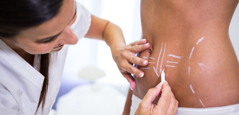 Lipoaspiração x hidrolipo: quais as diferenças entre os procedimentos?